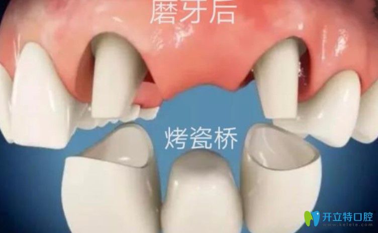 剛戴上全瓷牙咬東西疼是咋回事？趕緊戳進(jìn)來(lái)看看吧