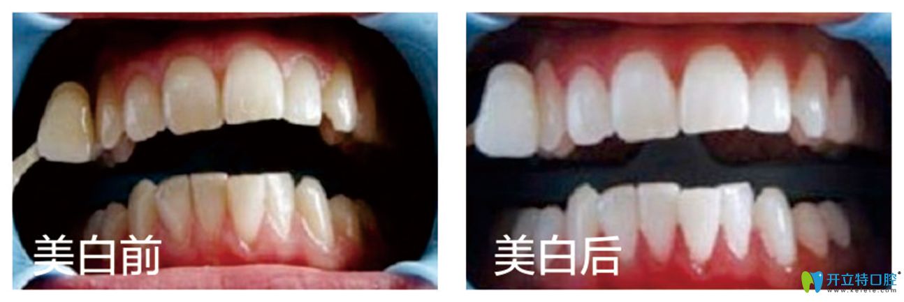 泉州晉江修大夫牙科皓齒美白案例