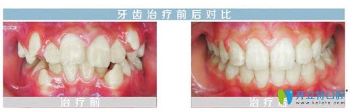 舌側(cè)隱形牙套矯正虎牙前后對比照