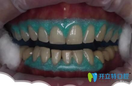 皓齒美白牙齦保護劑