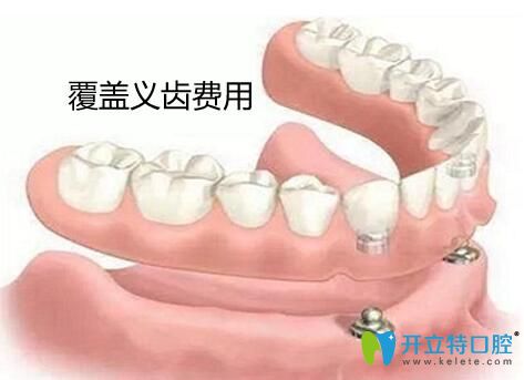 種植覆蓋義齒價格