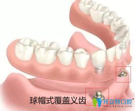 價(jià)格吊打種植牙的全口覆蓋義齒修復(fù)到底有哪些優(yōu)缺點(diǎn)？