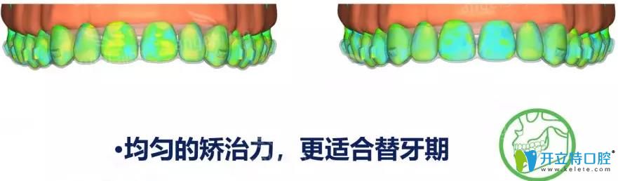 時代天使kid矯正均勻的矯治力度