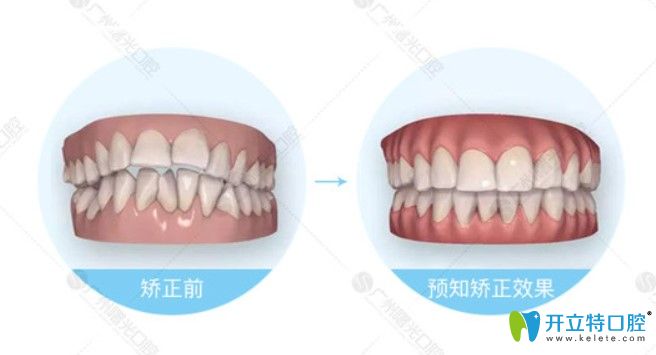 齙牙矯正前后3d效果圖 齙牙矯正前后3d效果圖