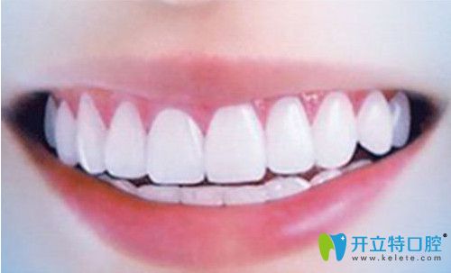 美白牙齒活動(dòng)詳情