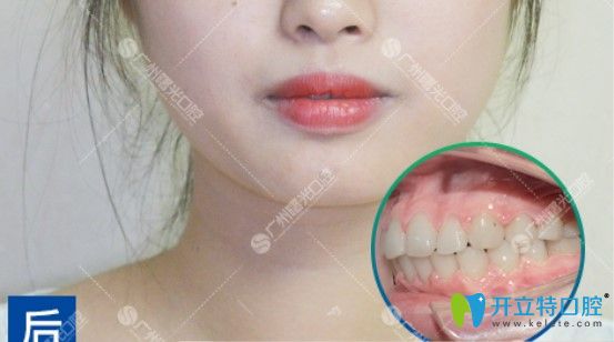 齙牙做完時(shí)代天使矯正后的樣子 齙牙做完時(shí)代天使矯正后的樣子