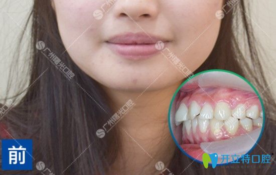 沒(méi)做矯正之前的牙齒情況 沒(méi)做矯正之前的牙齒情況