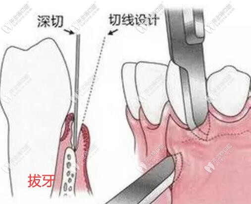 小姐姐親身經(jīng)歷了超聲骨刀拔橫生智齒后說比普通拔牙好