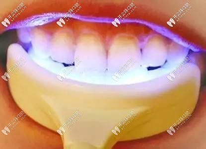 美牙儀使用方法