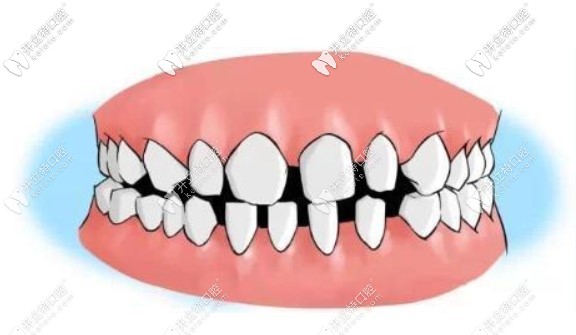 我的牙縫很大，到底需不需要補(bǔ)呀