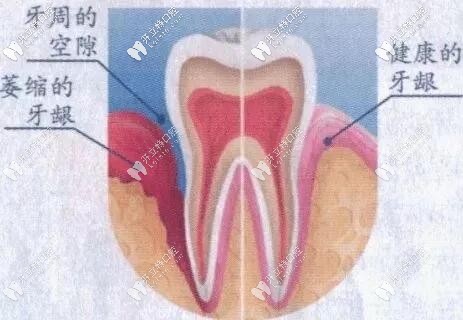 牙齦對(duì)比圖