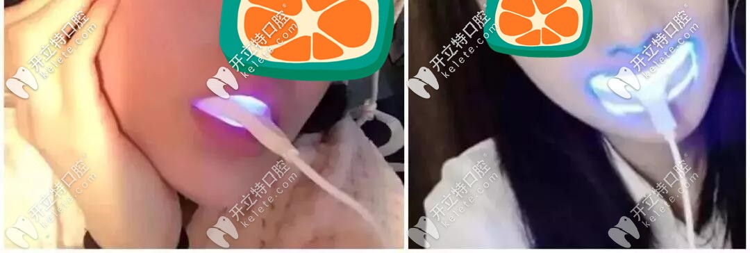 正在使用美牙儀圖示