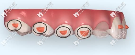 Invisalign first兒童矯正技術(shù) Invisalign first兒童矯正技術(shù)