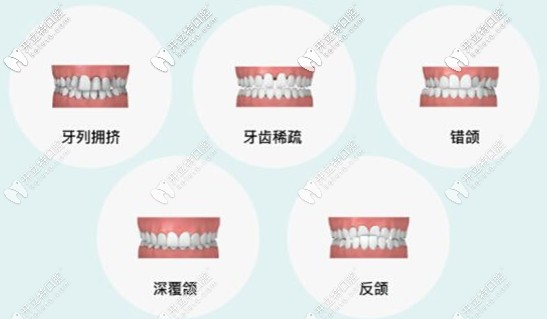六大情況適合隱適美矯正 六大情況適合隱適美矯正
