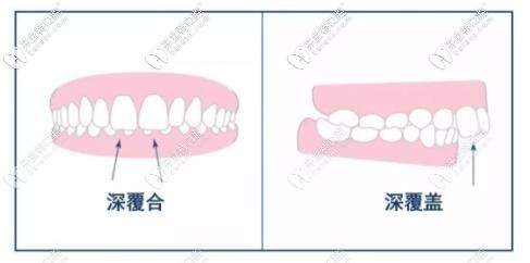 深覆合和深覆蓋的區(qū)別圖片
