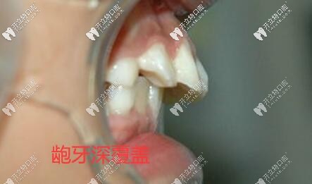 要不是骨性齙牙我不會(huì)選擇比隱形牙套貴的舌側(cè)矯正