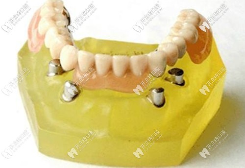 長期戴用過渡性義齒是會(huì)引起牙齦萎縮的