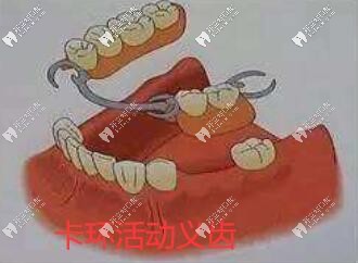 局部 卡環(huán)活動(dòng)義齒