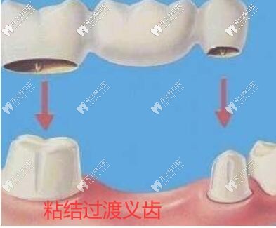 粘結(jié)烤瓷牙