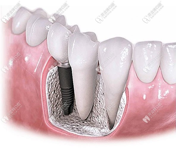 種植牙活動詳情