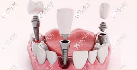 科普什么是美國(guó)皓圣種植體