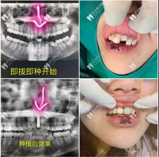 門牙磕斷不能保留，即拔即種種植牙當(dāng)天就能擁有好牙