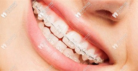 陶瓷半隱形牙套活動(dòng)