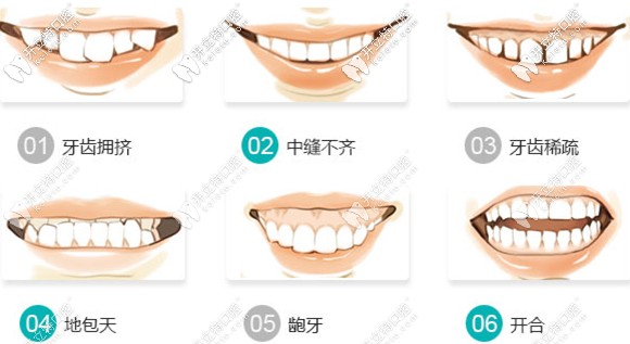 在溫州藝星口腔簡(jiǎn)單矯正病例6980元起