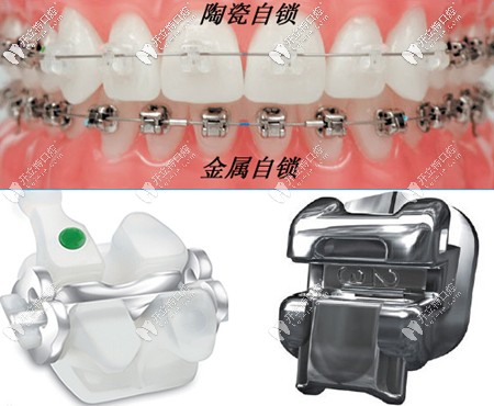 金屬和陶瓷自鎖矯正的區(qū)別圖