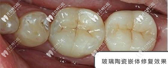 玻璃陶瓷材料修復(fù)口內(nèi)照