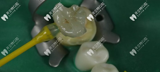 玻璃陶瓷嵌體使用年限較長