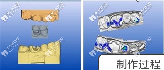 修復(fù)完成后牙齒咀嚼效率會(huì)比較高