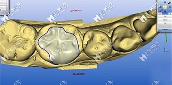 玻璃陶瓷嵌體的缺點(diǎn)是對于真牙缺損大的牙不適合