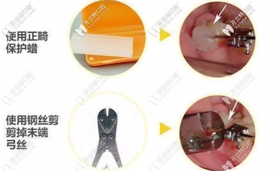 托槽脫落的處理方法