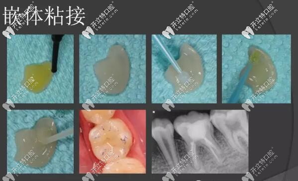 嵌體補(bǔ)牙過程