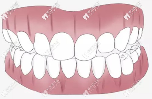 牙周整形術(shù)是什么 牙周整形術(shù)是什么