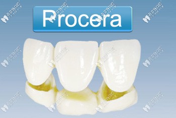 瑞典procera全瓷牙