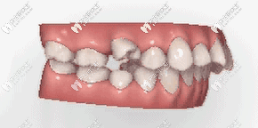 超全科普：隱適美推磨牙向后知識全都在這里了