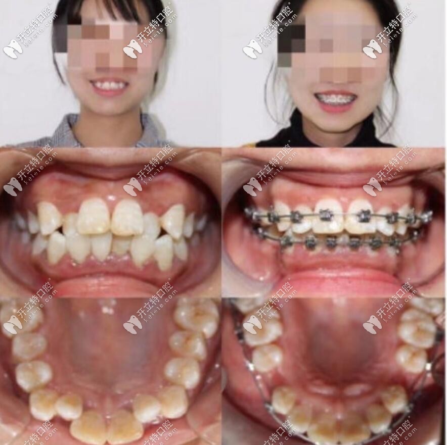 汕頭華美口腔鋼絲矯正案例