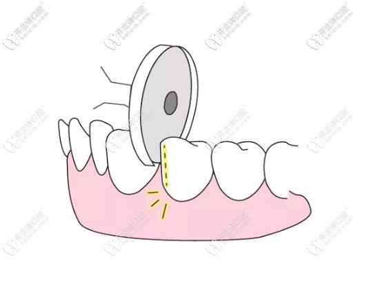 漲姿勢(shì)：片切和拔牙的利弊你真的清楚嗎？