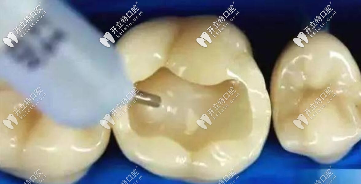 樹(shù)脂嵌體和瓷嵌體價(jià)格相差那么大，到底有啥區(qū)別？