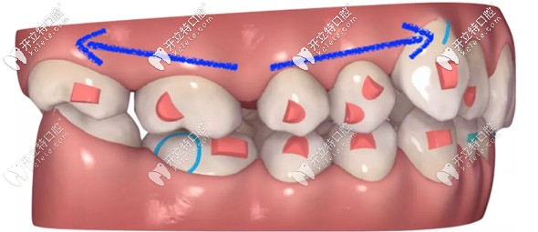 在推磨牙過(guò)程中前牙也會(huì)有向前的力量