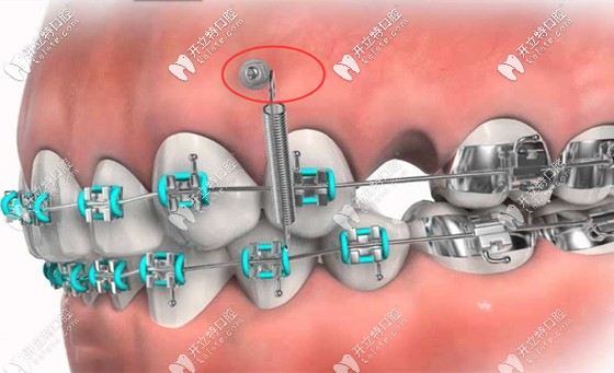 正畸種植釘?shù)淖⒁馐马?xiàng)