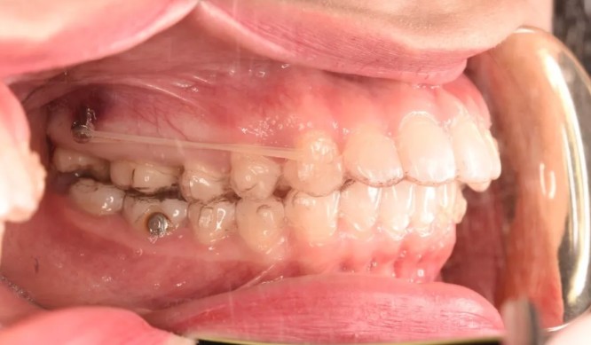 妹紙做隱適美磨牙后推打骨釘?shù)恼澜?jīng)歷,沒想到效果挺不錯