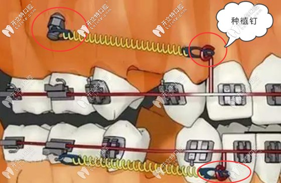 你們都在意正畸種植釘?shù)淖饔?而我更關(guān)心打骨釘什么感覺(jué)