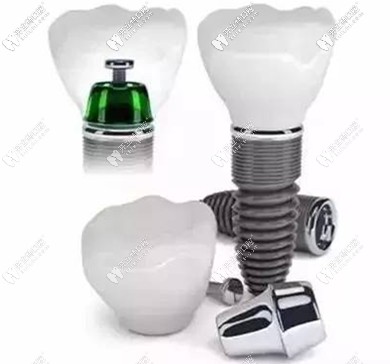 種牙選好植體是關(guān)鍵，醫(yī)生技術(shù)更關(guān)鍵