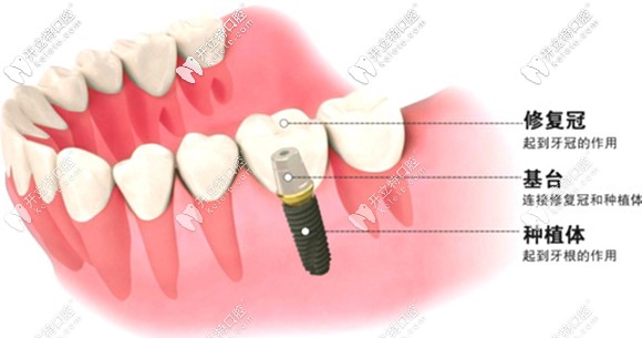 種植牙韓國和瑞士的差別