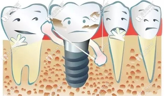 種植牙瑞士和韓國哪個好