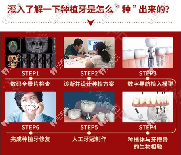 種植牙手術(shù)過程圖解