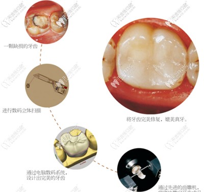 現(xiàn)技術(shù)瓷貼面兩小時就可以完成